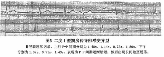 窦房传导阻滞 症状 治疗