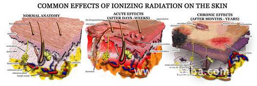 放射性皮炎(radiodermatitus)