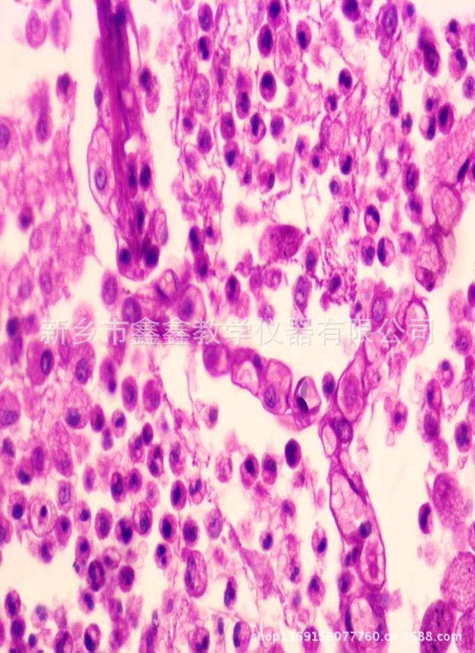 大叶性肺炎（灰色肝样变期）