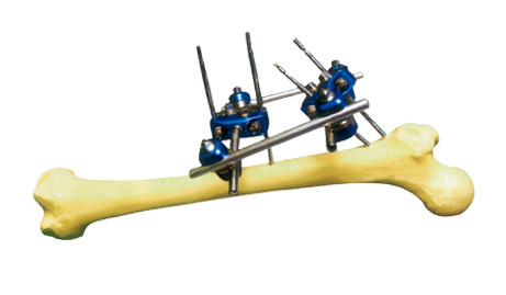 【供应骨科外固定支架系统--组合式支架I--股骨