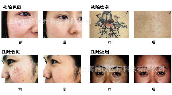 激光治疗案例