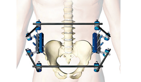 一次性医用耗材-供应骨科外固定支架系统--组合