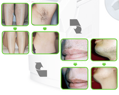批发采购美容仪器-808半导体激光脱毛机器---厂