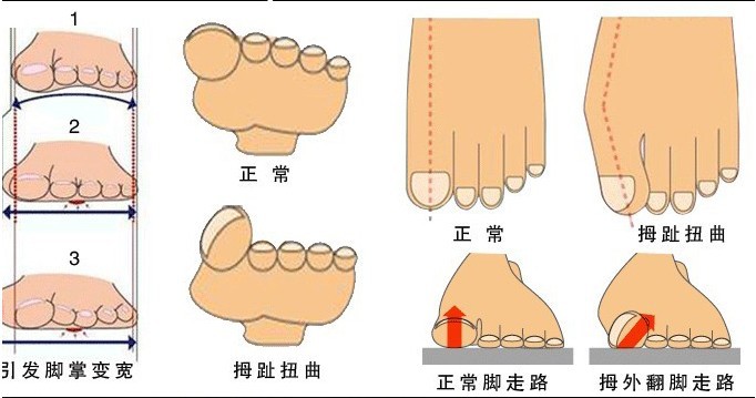 拇外翻分趾器矫正器分趾垫脚趾分离器硅胶脚趾分离垫 2个装