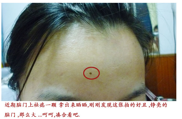 怎样在家自己去痦子,去痦子,痦子_大山谷图库